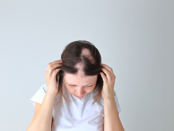 Alopecia na nrọ