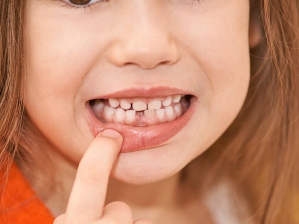 تسوس الاسنان عند الاطفال | نواعم