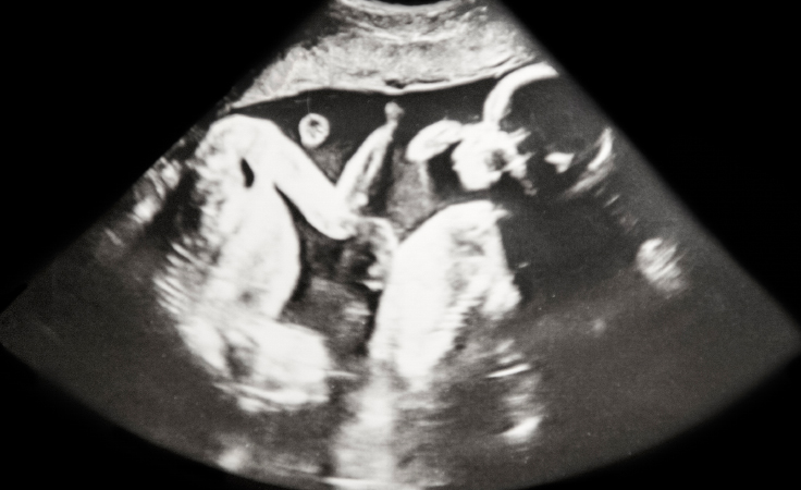 6 عوامل تزيد فرص الحمل بتوأم مبكر