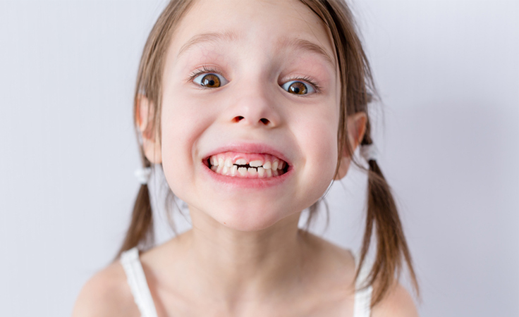 ما يجب أن تعرفيه عن تساقط أسنان الحليب لدى طفلك