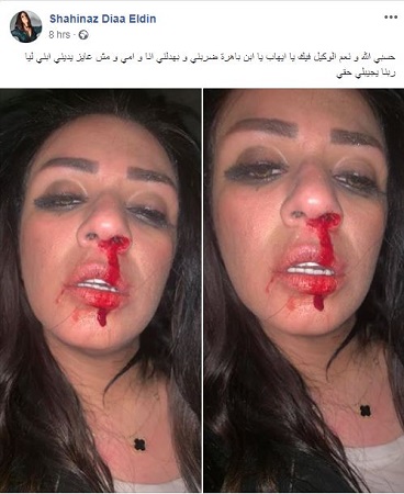 صورة.. زوج نجمة ستار أكاديمي يشوّه وجهها